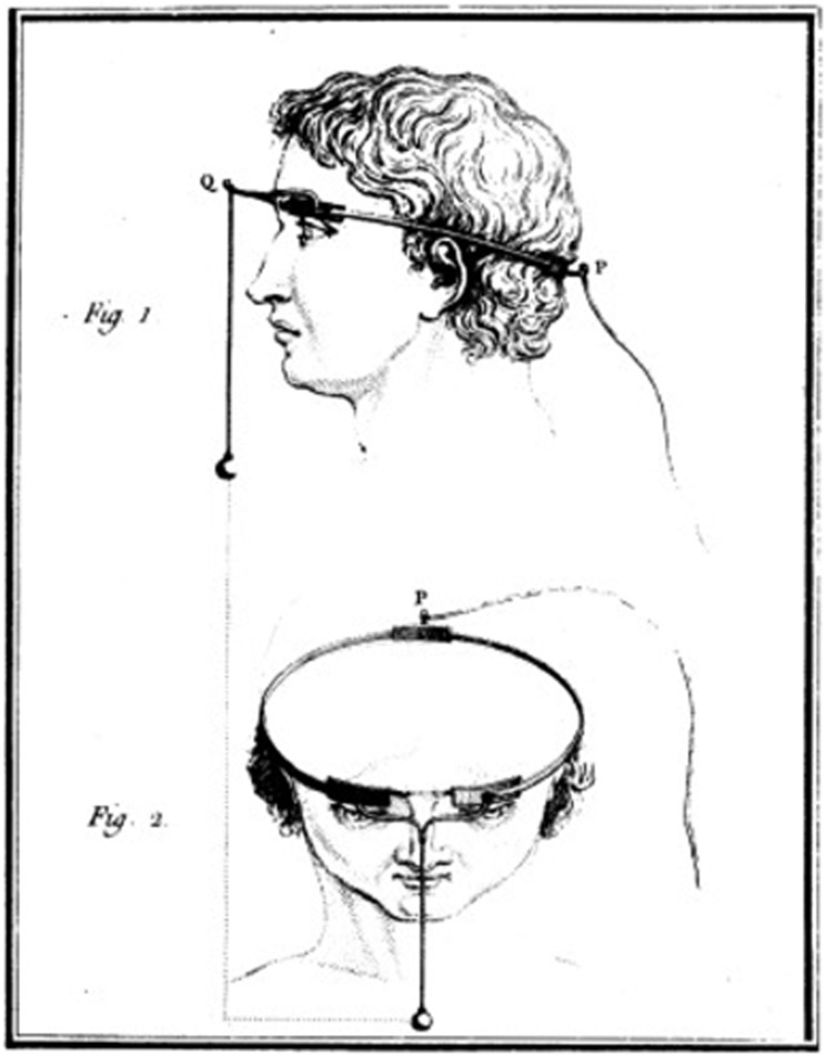 Method used by Charles Le Roy to evoke visual disturbances in a blind volunteer: A wire was wrapped around the patient's head with current applied through it