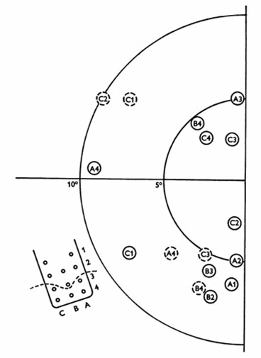 Phosphene map in the visual field for case no. 36. The electrode array and numbering system are also shown, along with a dashed line showing the postulated position of the calcarine fissure