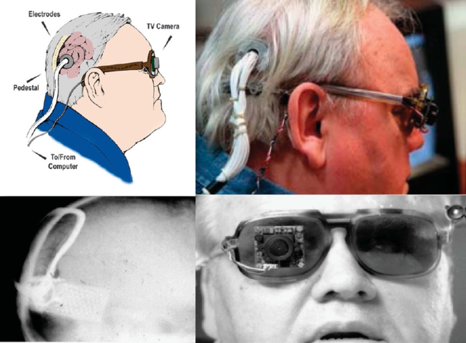 Different views of a recipient of the Dobelle implant, first implanted in 1978
