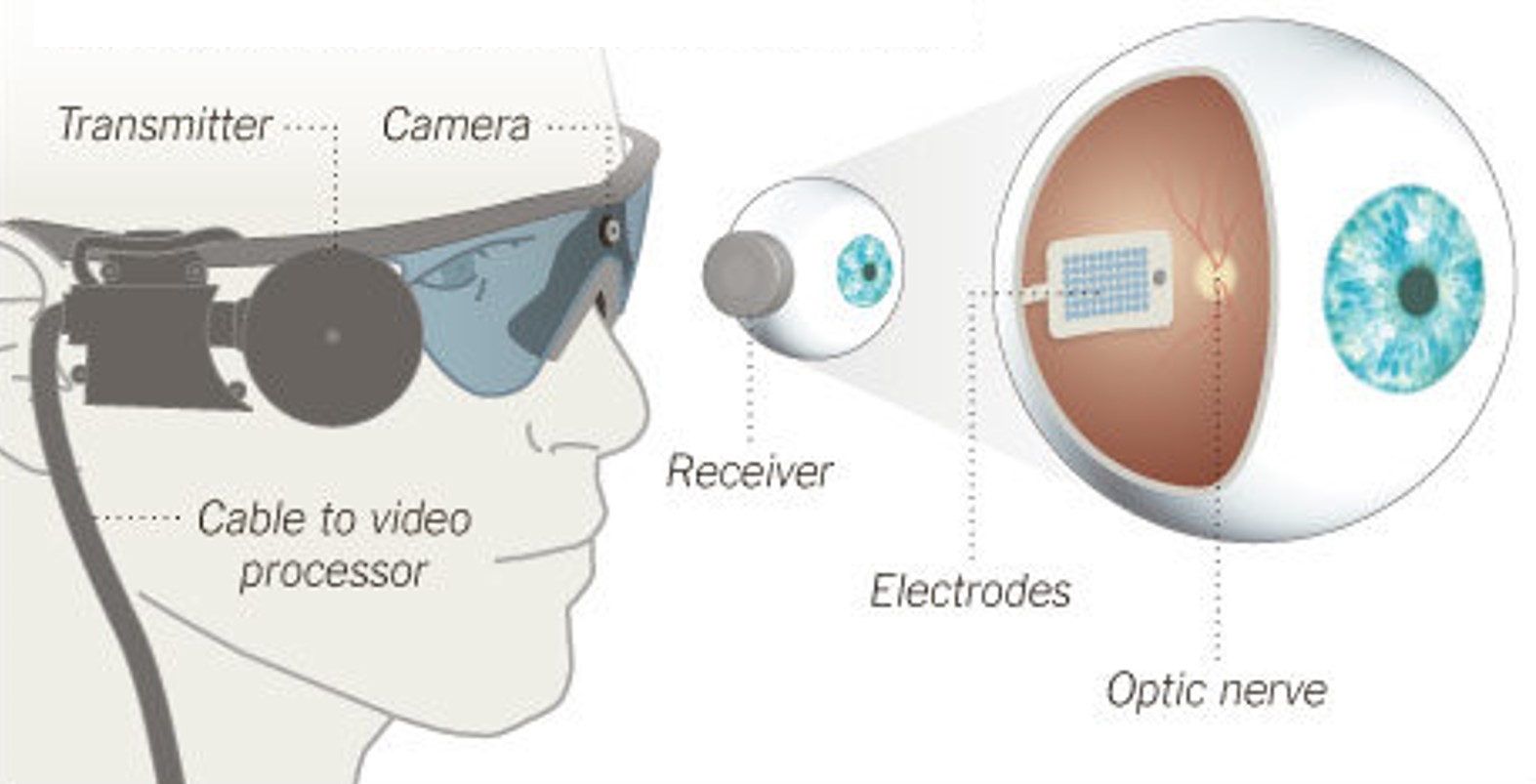 Argus II Retinal Prosthesis System (Source: Second Sight). Camera images are processed and transferred to electrodes implanted in the back of the eye