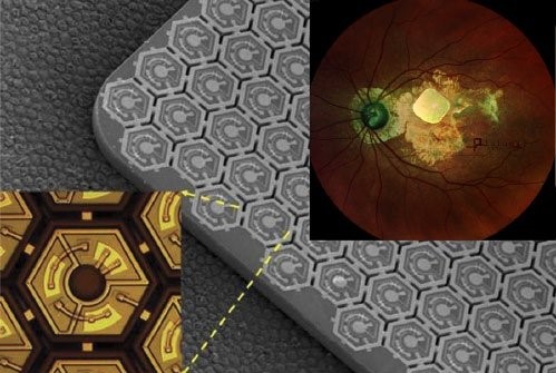 PRIMA, a subretinal implant consisting of ~400 photovoltaic cells (Source: Pixium Vision)